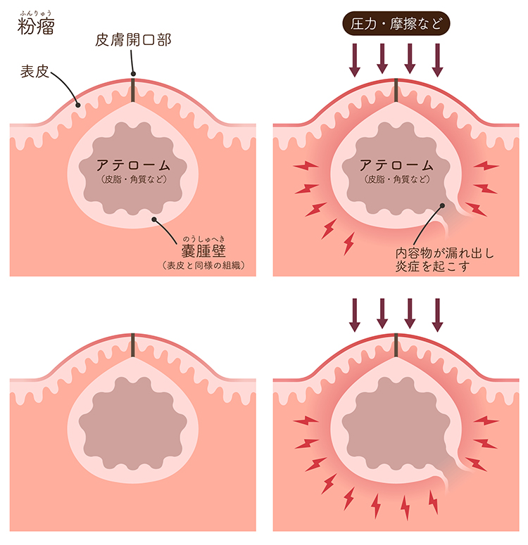 粉瘤が出来やすい人