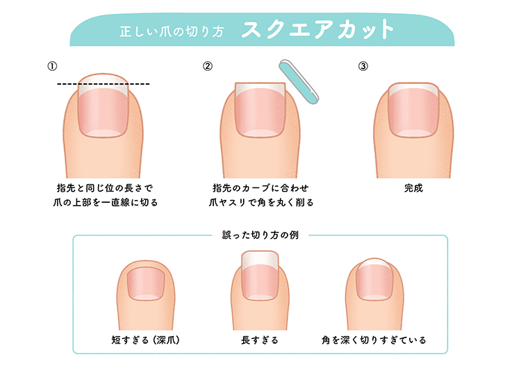 巻き爪・陥入爪の予防・注意事項